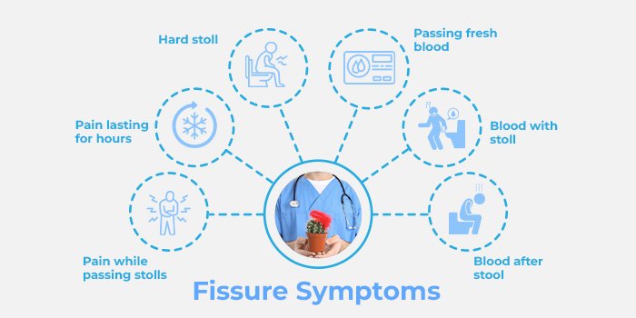 Fissure Symptoms